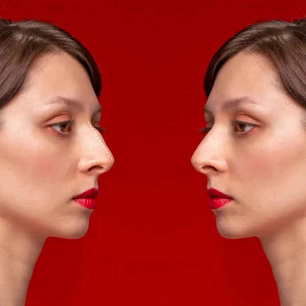 تجميل الأنف